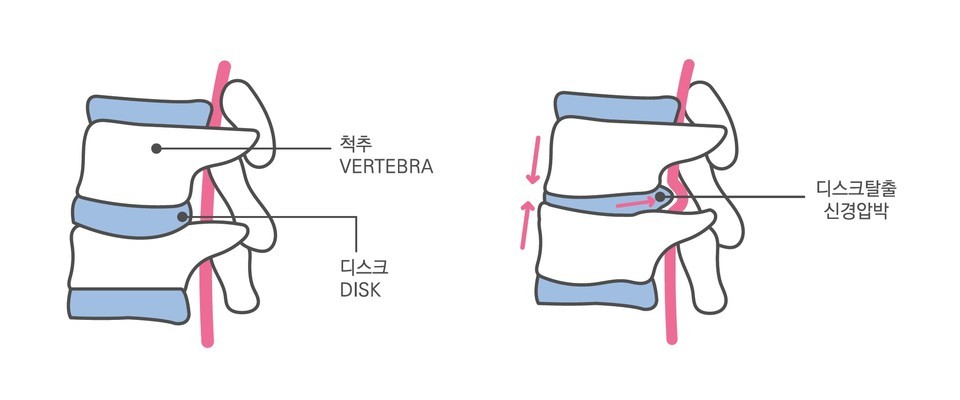 김해뉴스, 1cm의 마법 '척추 내시경수술' 썸네일 이미지